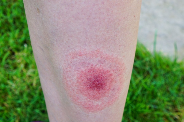 tick bite on skin