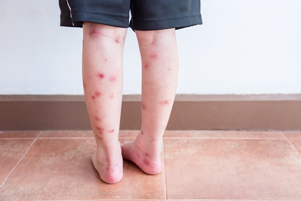bed bug bites on back of legs
