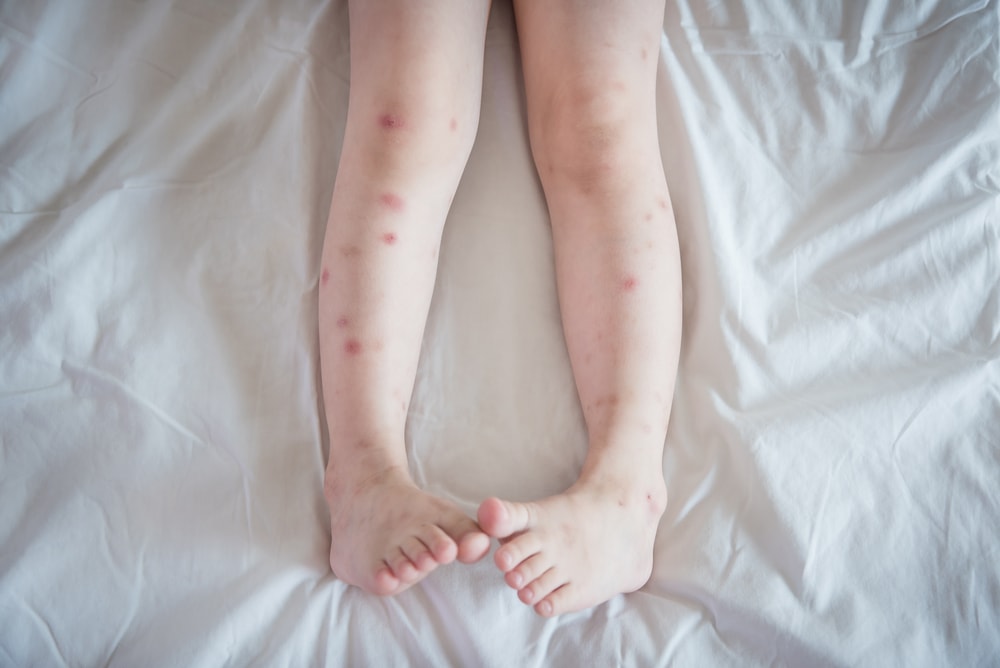 bed-bug-bites