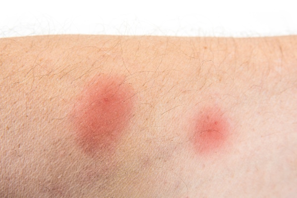 Spider bite