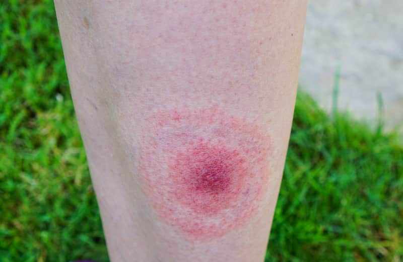 lyme disease